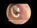 Otomycosis with csom  fungus in ear with perforated tympanic membrane