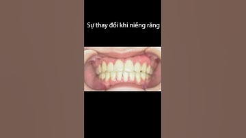 Kết quả trước và sau khi niềng răng móm của Thảo Trinh