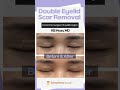 Revision blepharoplasty  double eyelid scar removal surgery