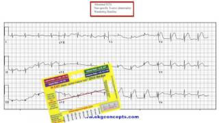 EKG Concepts - 12 Lead EKG - Case Study 01