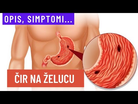 Video: Kako prepoznati simptome čira na želucu: 10 koraka