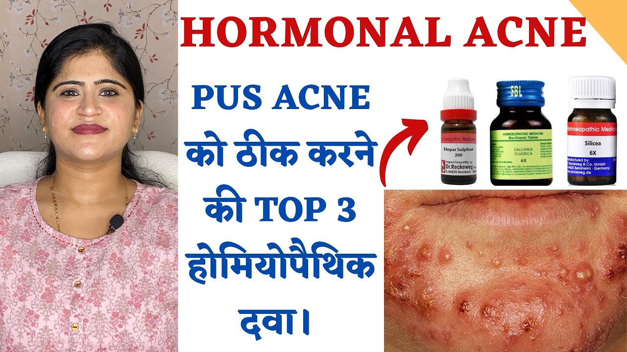 Hormonal Cystic Acne Treatment ॥ Pus Acne को ठीक करने की TOP 3 होमियोपैथिक दवा।