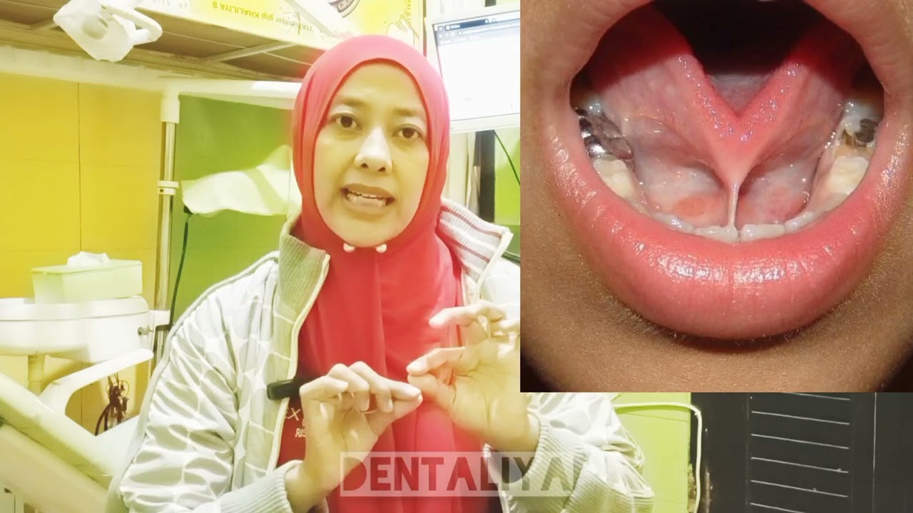 SOLUSI CADEL, GAK BISA SEBUT R, SEBAB & SOLUSI FRENECTOMY