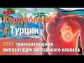 Кардиология и лечение сердца в Турции. Имплантация аортального клапана малоинвазивным методом TAVI.