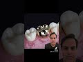 Porcelain Fused To Metal Crowns Vs Gold Crowns Gold Porcelain Crown Dentistry 