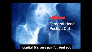 Why Your Hips Hurt: Common Arthritis Causes &amp; Early Warning Signs