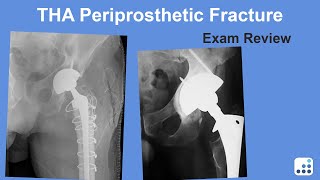 Periprosthetic Fracture Exam Review - Wayne Paprosky, MD