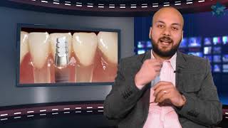 انواع زراعة الأسنان - دكتور بيتر وديع  اخصائى زراعة  وتركيب الاسنان