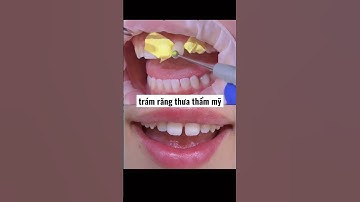 trám răng thưa thẩm mỹ #dental #dentist #shortvideo #veneers #shorts #shorts #short