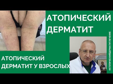 Атопический дерматит. Атопический дерматит лечение. Часть 2.