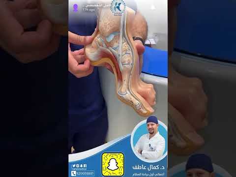 تمزق وتر العرقوب