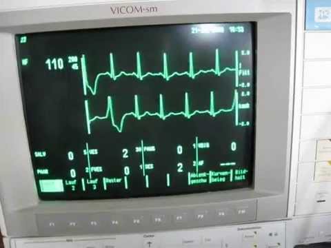 the valsalva maneuver and sinustachycardia / cardi...