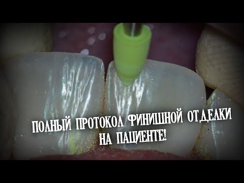 Полный протокол финишной отделки на пациенте!