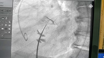 Septal puncture during pbmv