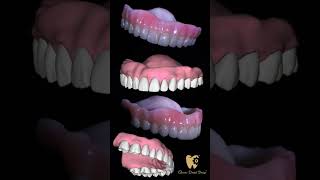 Denture 😁 #exocad #teeth #dentaldesign #dentistry