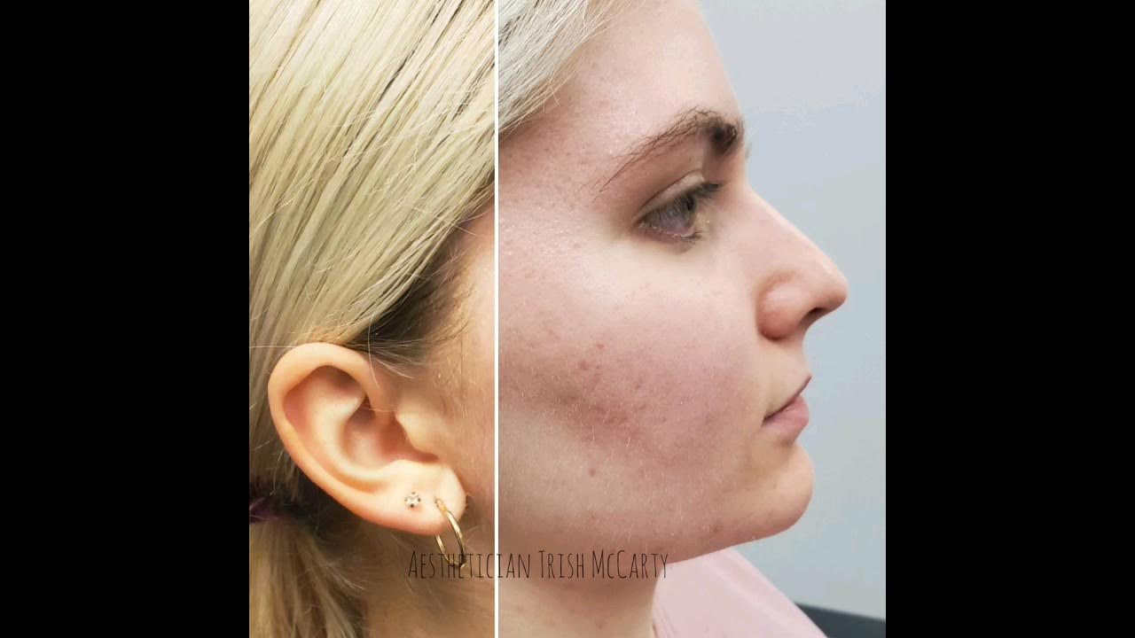 ️ Acne scars with Halo Laser Sciton Real Results ️ YouTube