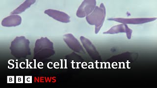 UK approves gene therapy to cure two blood disorders - BBC News