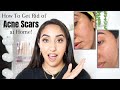 How I Got Rid Of My Acne Scars at Home!