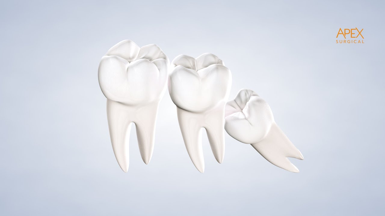 ⁣Instructions: Wisdom Tooth Removal at APEX Surgical Centre in Kamloops, BC