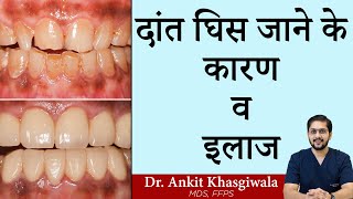 दांत घिस जाने के कारण व इलाज | Dr. Ankit Khasgiwala | Seraphic Dental | Indore by SERAPHIC DENTAL CLINIC INDORE 2,040 views 2 months ago 11 minutes, 5 seconds