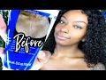 Acne Wash That Saved My Life! Panoxyl Body acne routine