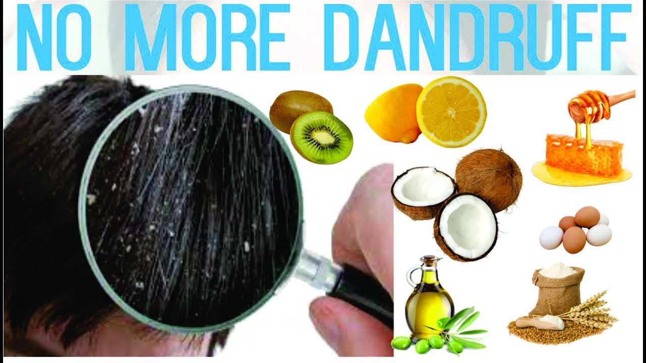 Watch How to Prevent and Treat Dandruff video Watch How to Prevent and Treat Dandruff video