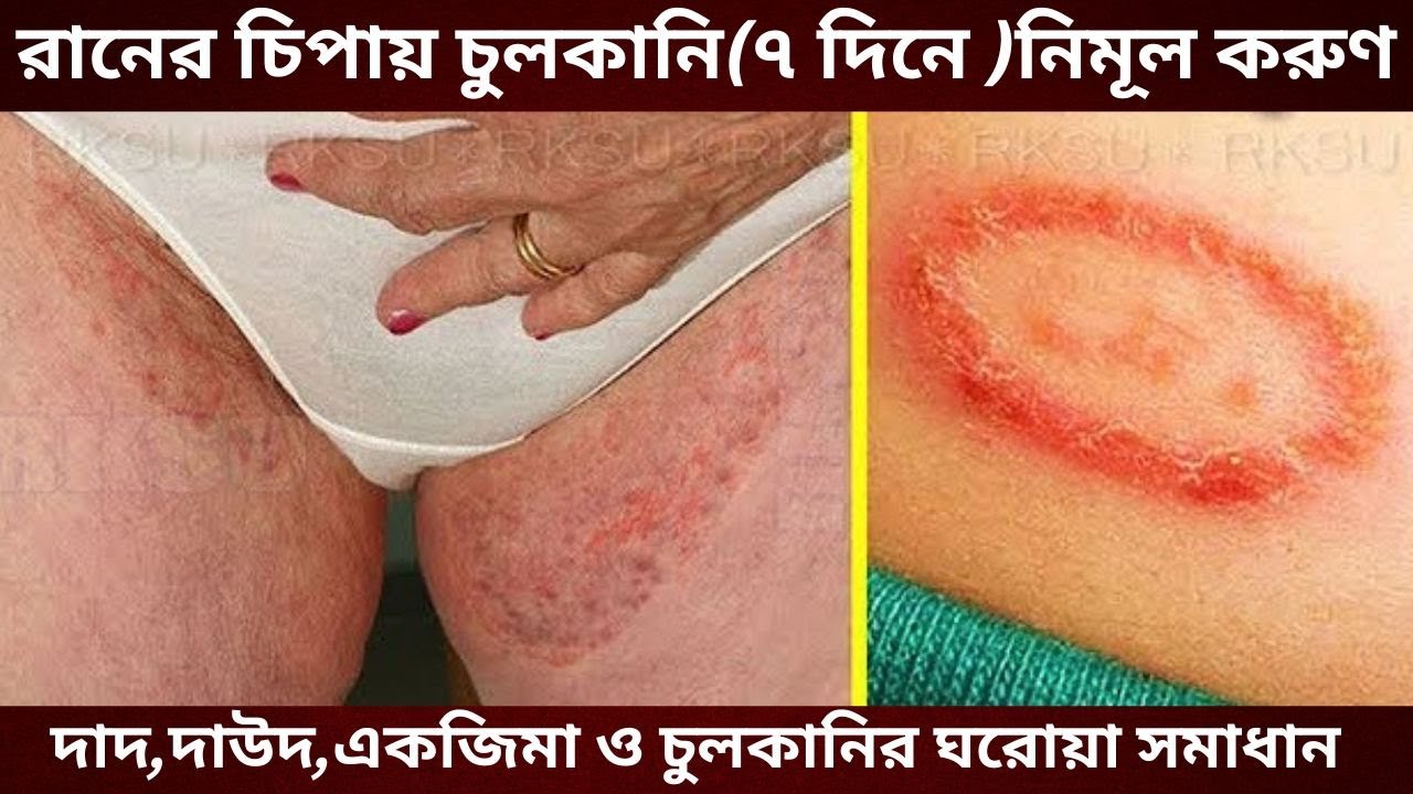 রানের চিপায় চুলকানির (Itching in the groin area) সমস্যায় ভোগছেন মাত্র সাত দিনে সমাধান জেনে নিন