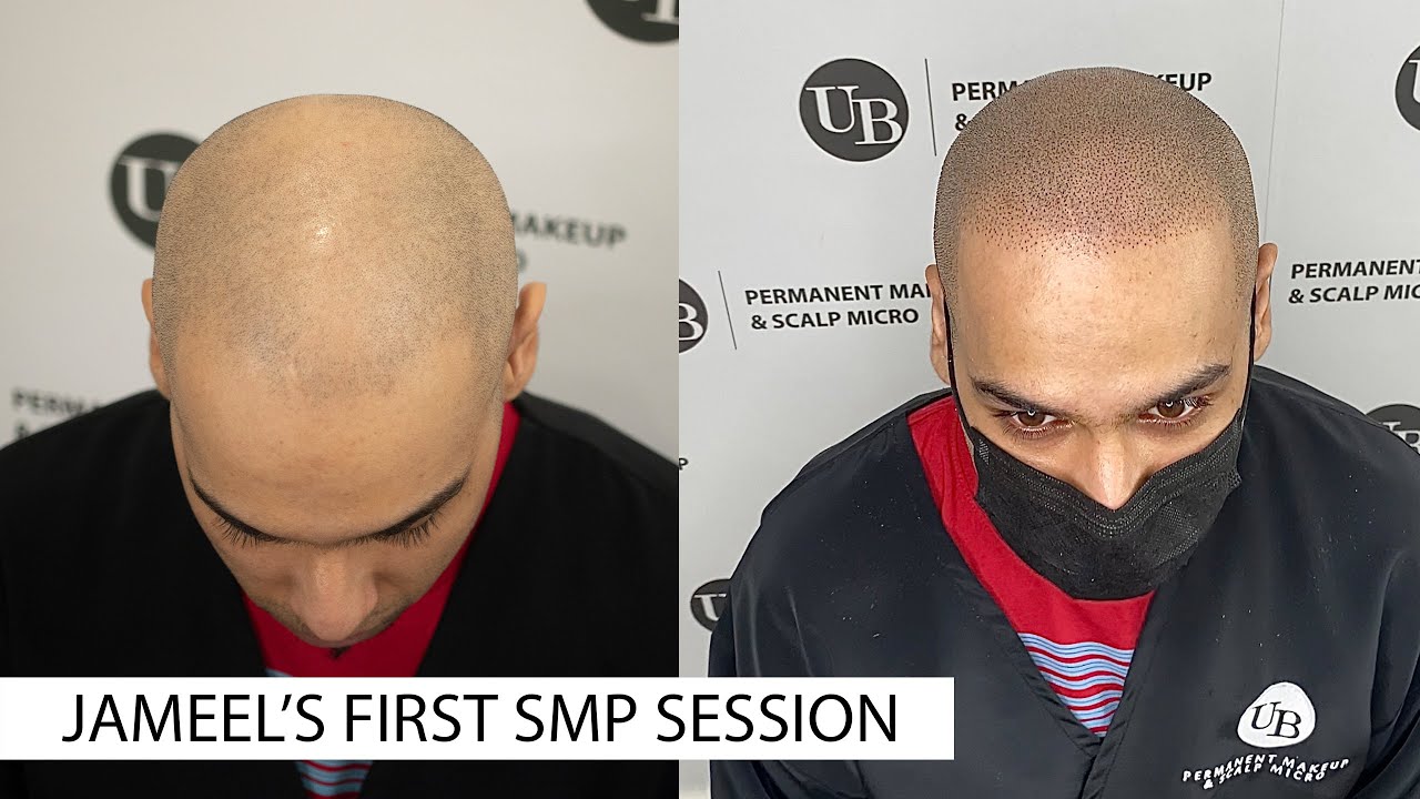 Jameel's SMP testimonial - Toronto Scalp Micropigmentation - YouTube
