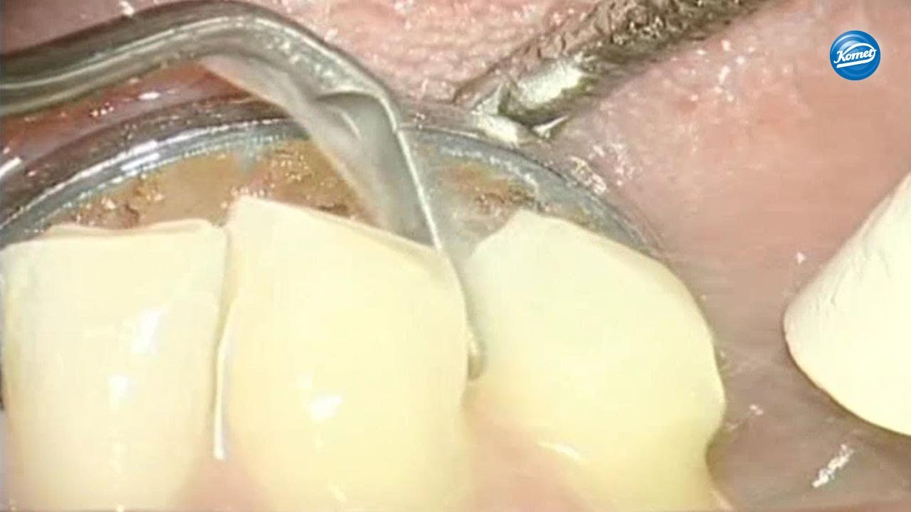 Kronenstumpfpräparation/Crown preparation, Dr. Agabiti Italien, Komet SonicLine