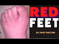 Red Feet: Rubor - A Sign of Poor Circulation in the Feet (Trimming Fungal Toenails)