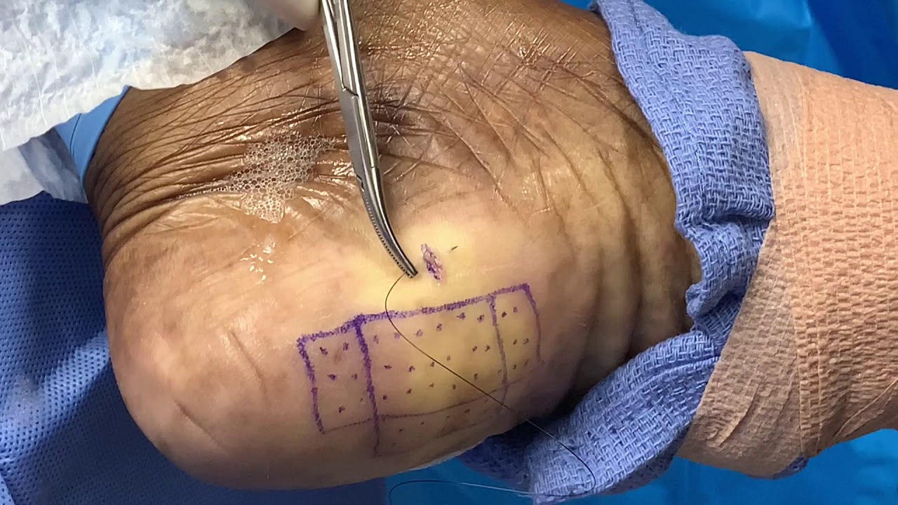 Retrocalcaneal Heel Spur Reduction and Repair of Achilles Te - YouTube