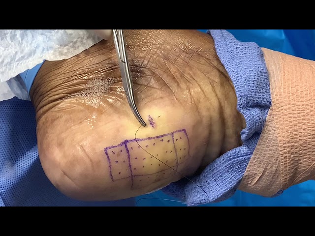 Figure 3 from A retrospective comparison of percutaneous plantar fasciotomy  and open plantar fasciotomy with heel spur resection. | Semantic Scholar