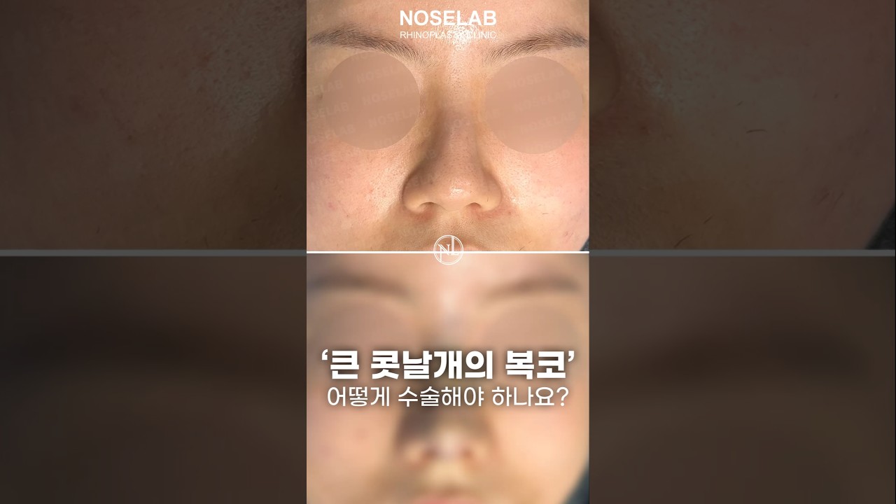 복코 교정과 녹지 않은 HA필러 제거, 자연스럽고 기능까지 살린 코성형 포인트