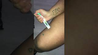 Injecting myself with dupixent (eczema)