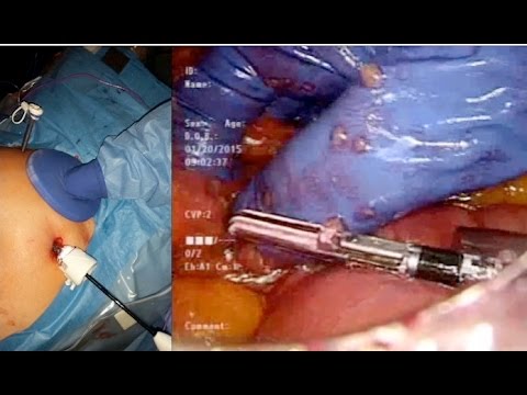 Home-made Hand-port Assisted Laparoscopic Sigmoid Colectomy