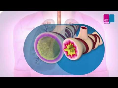 Video: Astma-classificatie: Soorten Astma En Hoe Ze Verschillen