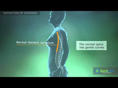 Kyphosis Definition