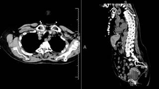 Spontaneous Epidural hematoma can mimic aortic dissection symptom and can be easily missed.