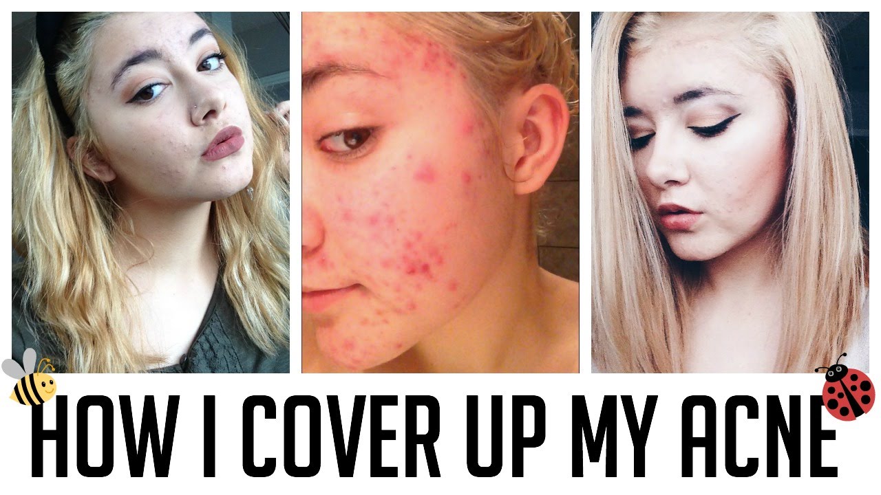 HOW TO COVER UP ACNE HOW I COVER UP MY ACNE MAKEUP TUTORIAL