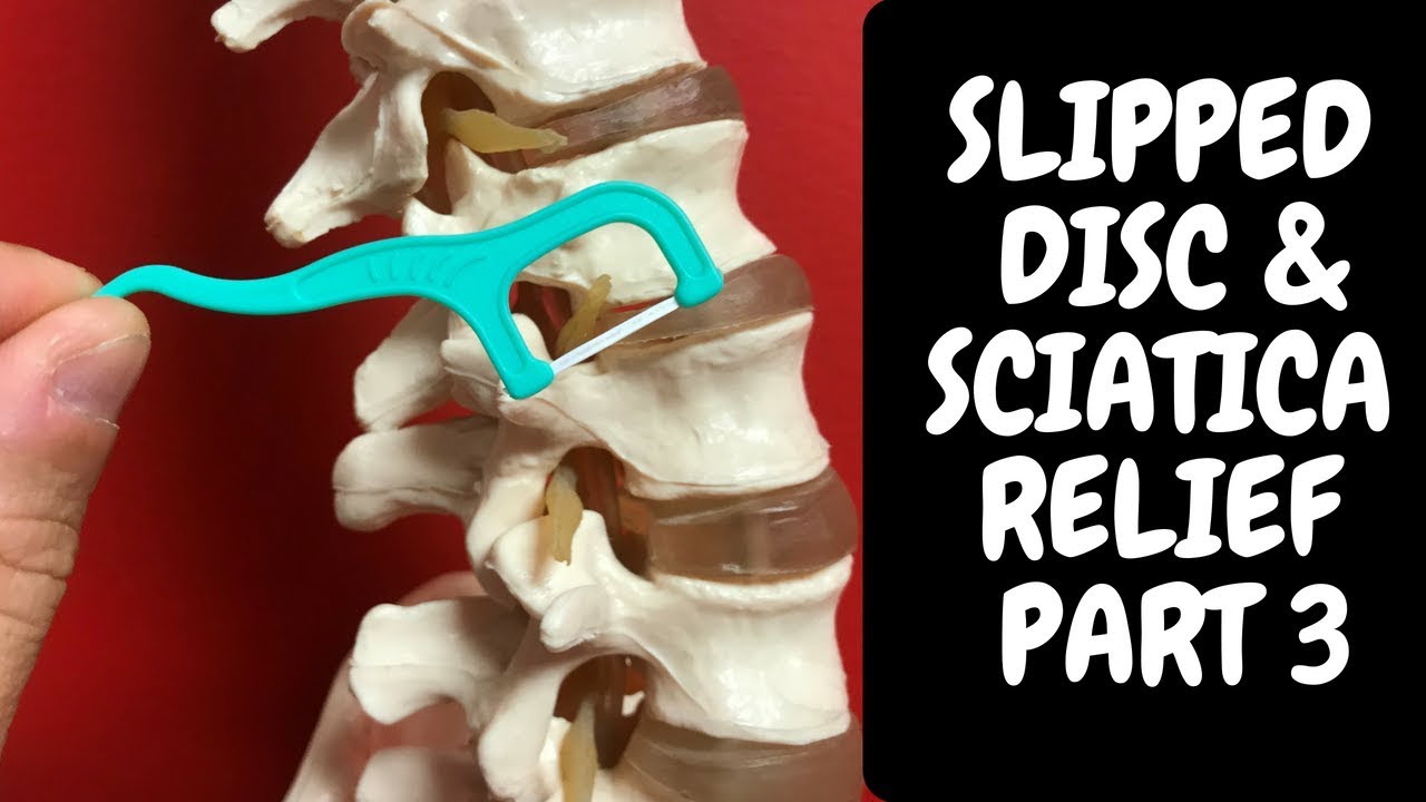 Slipped Disc & Sciatica Relief 3 Calgary Chiropractor Chiropractical YouTube