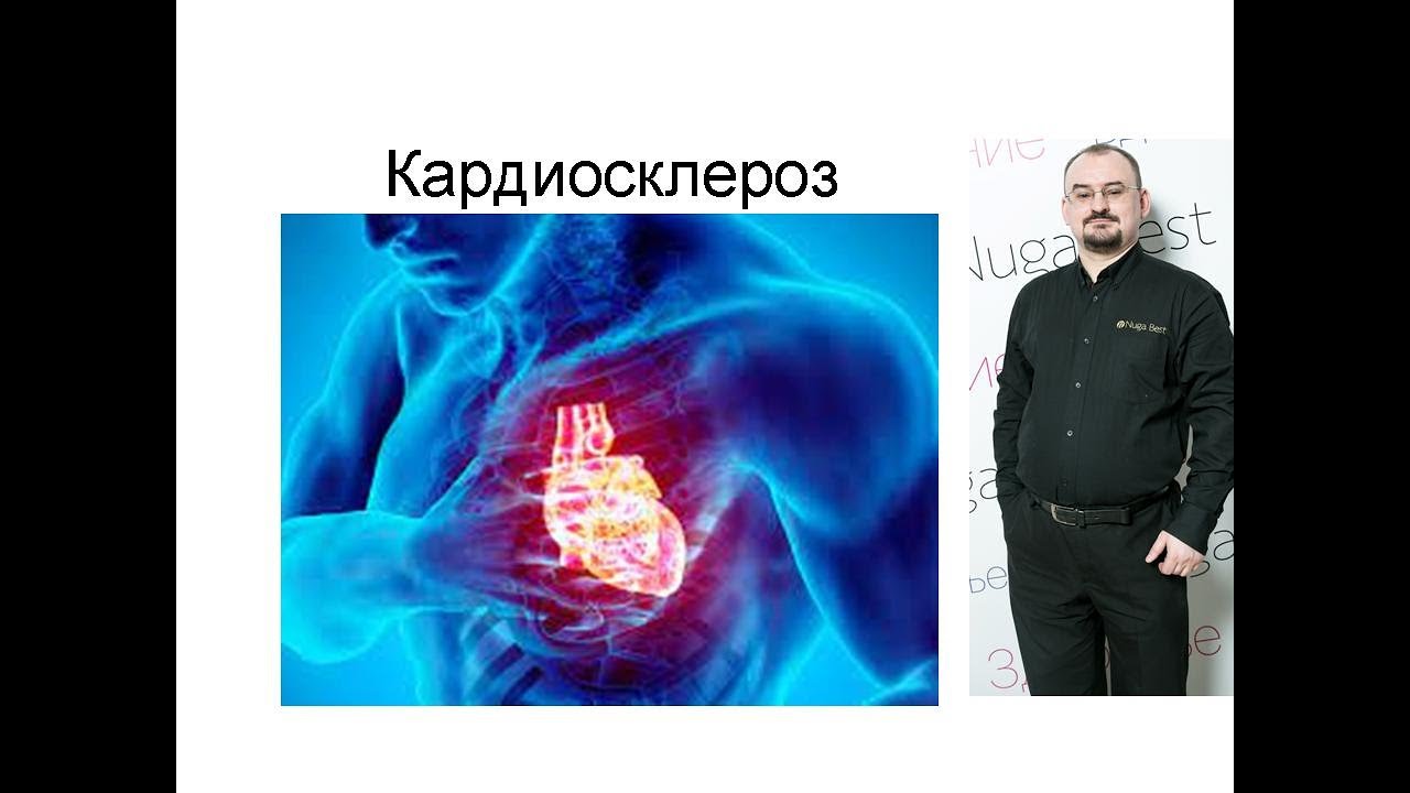 Кардиосклероз – проявление и лечение. - YouTube