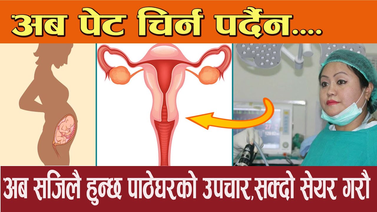 पाठेघरको शल्यक्रिया अव पेट चिरेर गर्न पर्दैन... - Mahila Swasthya
