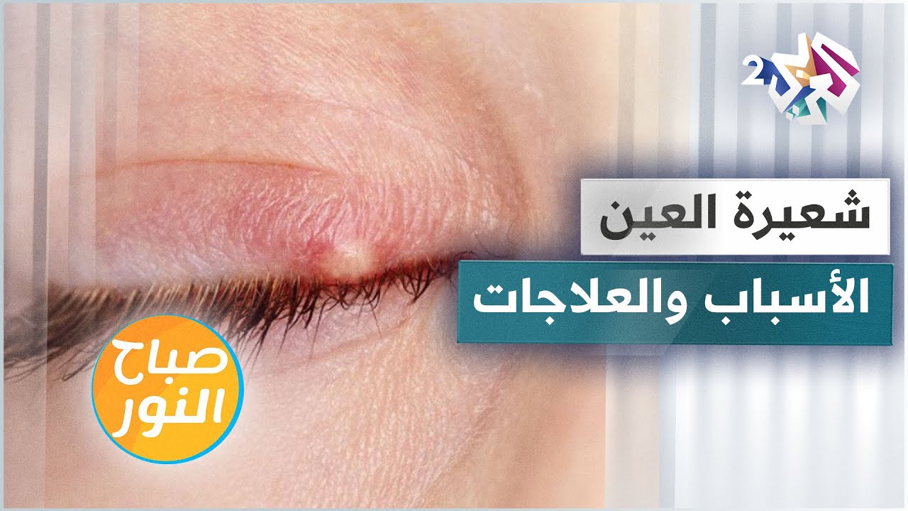 شعيرة العين .. الأسباب والأعراض والعلاجات
