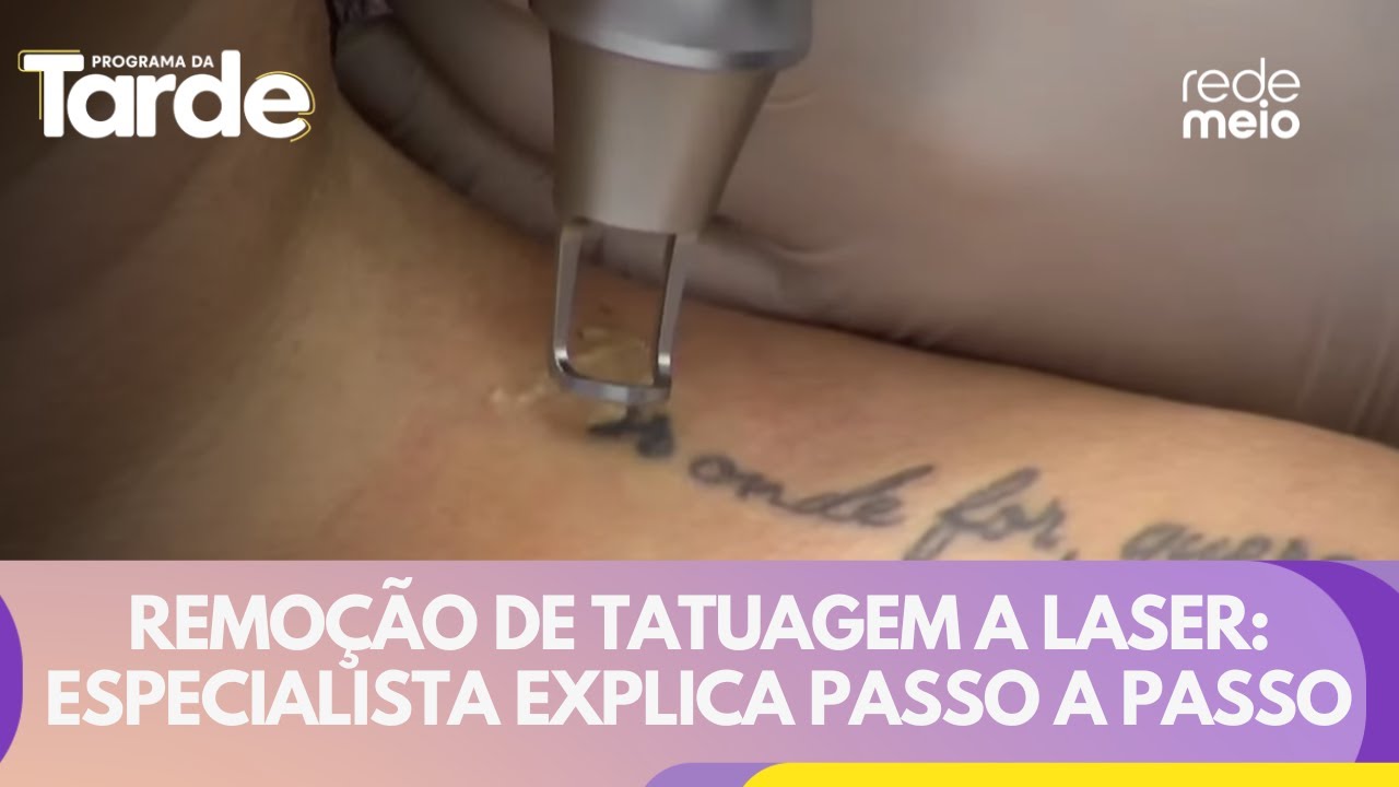 Remoção de tatuagem a laser: especialista explica passo a passo e tira-dúvidas | Programa da Tarde