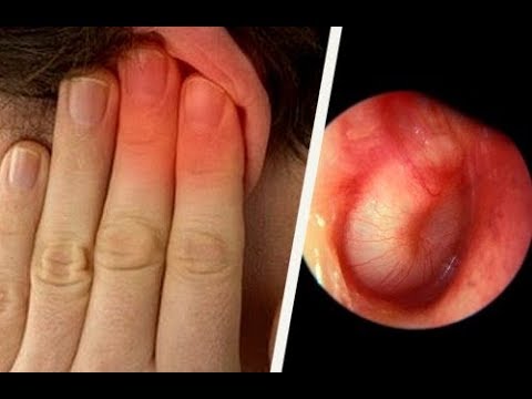 Vidéo: Comment traiter une infection de l'oreille