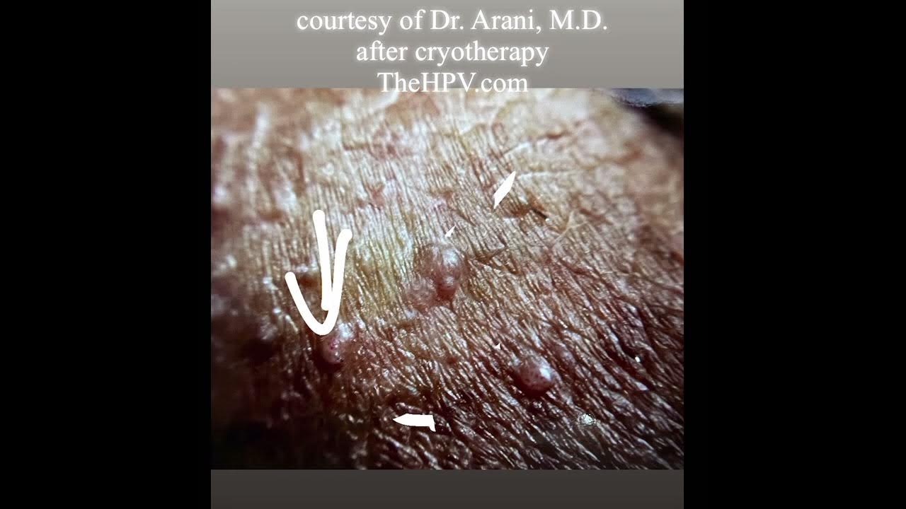 genital-warts-treated-by-cryotherapy-relapsed-in-3-new-locations-hpv