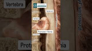 #emission #backrehab  #physicaltherapy #rehabilitation
