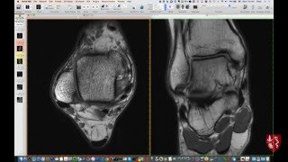 Systematic Interpretation of Ankle MRI: How I do it