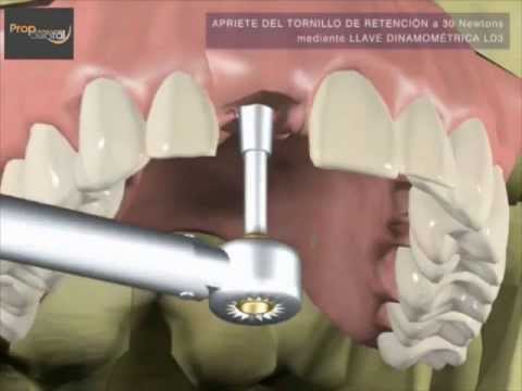 Vídeo: ¿Prótesis O Implantes Dentales?