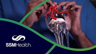 Genicular Artery Embolization To Treat Osteoarthritis